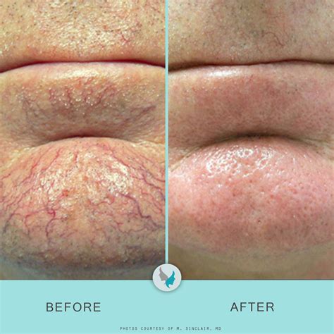 Laser therapy - Seawall Anti-aging Center