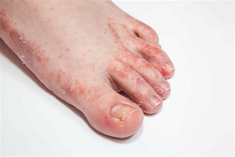 What's That Itch? Learn About Fungal, Bacterial, and Viral Skin Infections