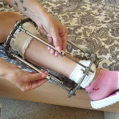 Apparatus of Ilizarov for bowleg correction