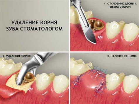 Швы после удаления зуба мудрости: почему нужны, какие нити используют ...