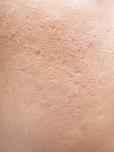 Cystic acne scars – Artofit