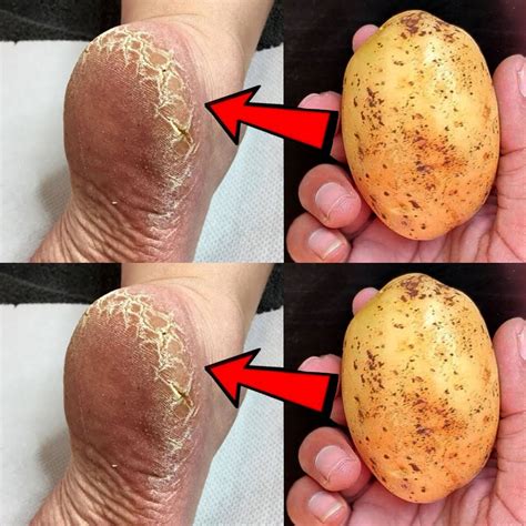 Eliminate Cracked Heels and Get White, Smooth Feet – iadun