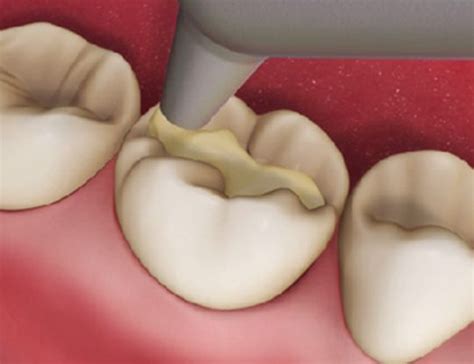 Composite Fillings For Teeth - Procedure And Precautions