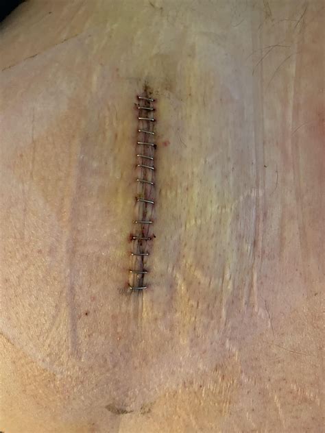 Infected incision? : r/DiagnoseMe