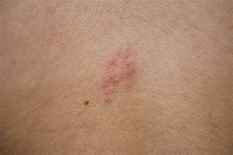 rash  shingles