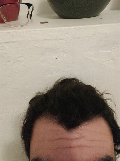 ls my hairline receding? 23M : r/malehairadvice