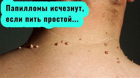 Могут ли папилломы исчезнуть сами (пройти, отвалиться), причины, чем ...