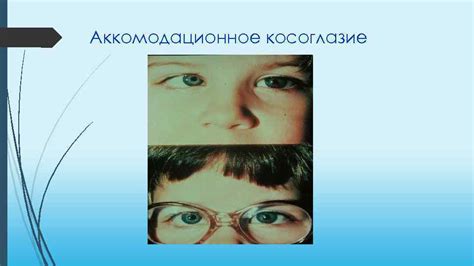 Косоглазие