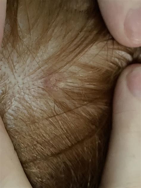 Scab on scalp been there for at least a year. It has hair, no lumps