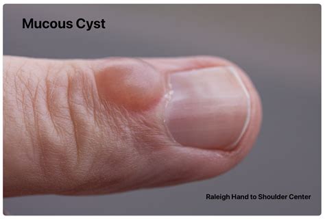 mucous cyst - John Erickson, MD