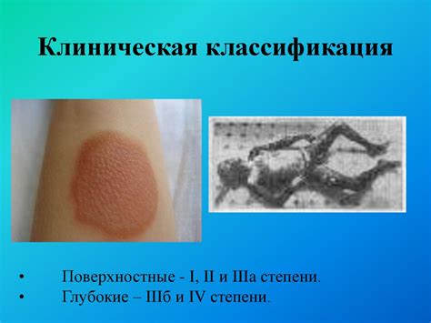 Ожоги. Термические ожоги. Химические ожоги. Электротравма. Лучевые ...
