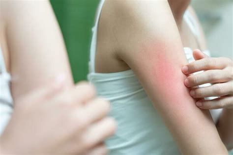 Bug Bite Stock Photos, Images and Backgrounds for Free Download
