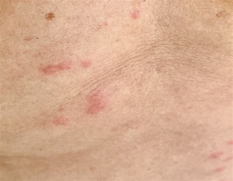 sand fly bites vs bed bugs