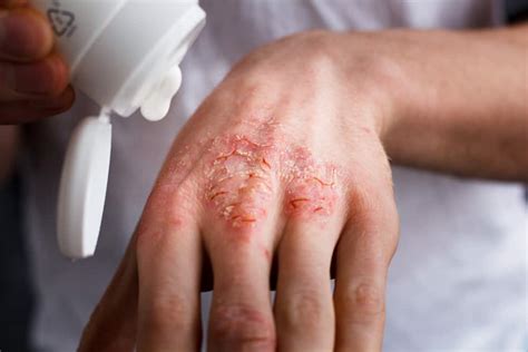 eczema treatment   options  home remedies  eczema