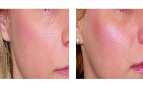 Cheek Augmentation using Radiesse Filler | Dermal fillers, Cheek ...