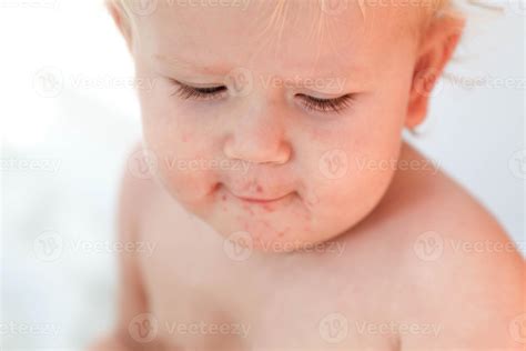 Portrait of a baby with a rash near the mouth. Enterovirus, allergy in