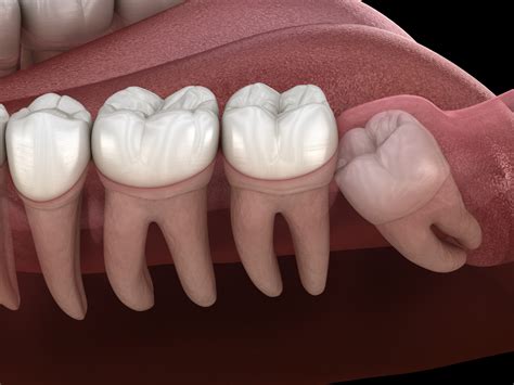 wisdom teeth recovery timeline tips