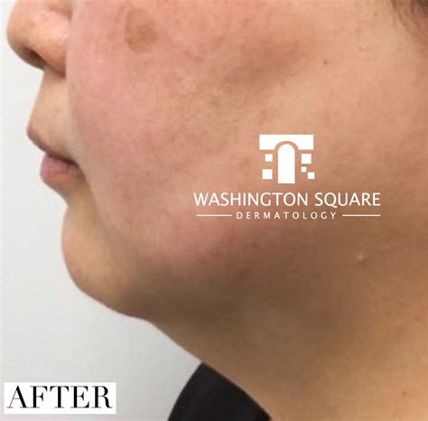 Kybella Injections in NYC - Washington Square Dermatology