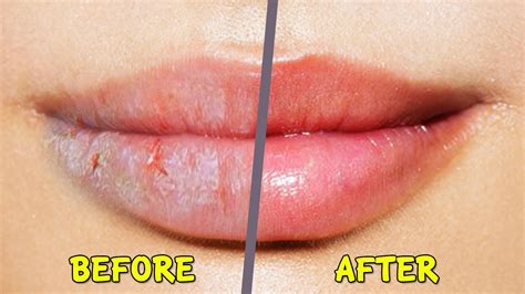 How To Fix Chapped Peeling Lips