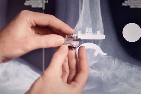 Ankle Replacement Surgery and Treatment Options | Exactech