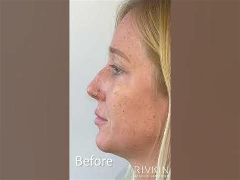 Permanent Nose Filler By Dr. Rivkin - YouTube