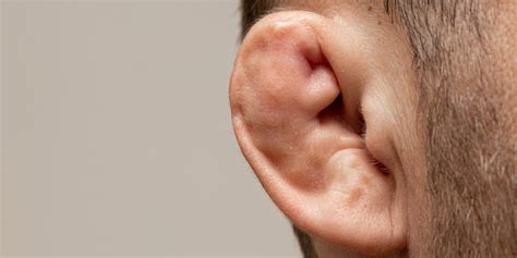 Treatment and Prevention of Cauliflower Ear | Sterosport