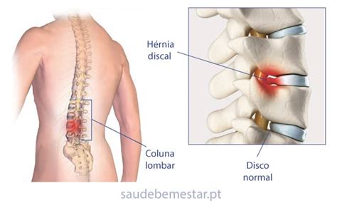 Hérnia De Disco Lombar L4 E L5 Sintomas - Fisioterapia e reabilitação na Hérnia Discal (de disco) Lombar