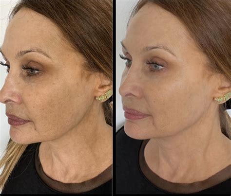Eye-Opening Truth About Omnilux LED Masks | Most Detailed Review ...