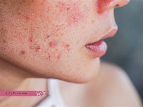 Nodular Acne Treatment: Comprehensive Guide - RemoteDerm