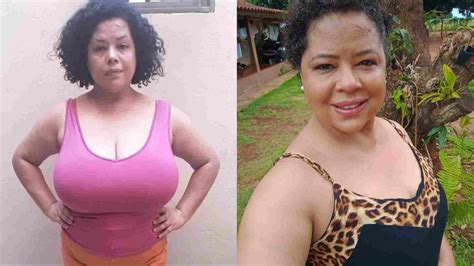 Redução De Mama Pelo Sus Antes E Depois - 'Vivia à base de remédios': cirurgia de redução de mama muda vida de ...