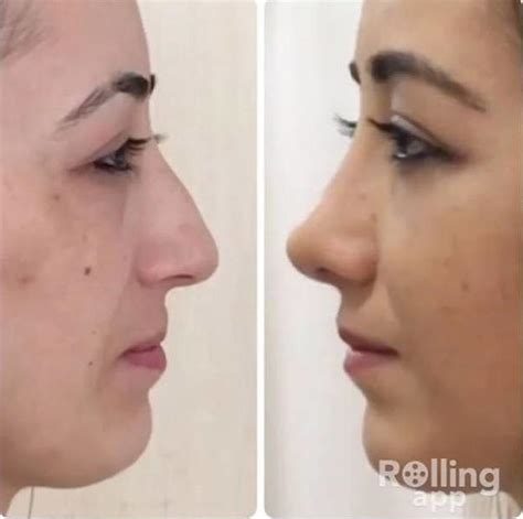 hooked nose   girl rhinoplasty cost pics reviews qa