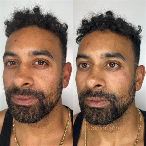 Cheek Fillers - Designer Aesthetics by Dr. Jarrett Schanzer | Miami