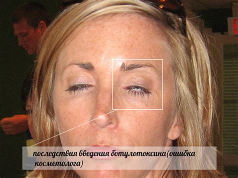 Последствия и побочные эффекты ботокса - отеки, птоз (опущение ...