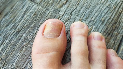 Perform Podiatry - Ingrown Toenail
