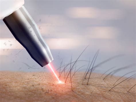 Perianal Depilação A Laser - Depilação a Laser Perianal Dói? Conheça esse Procedimento!
