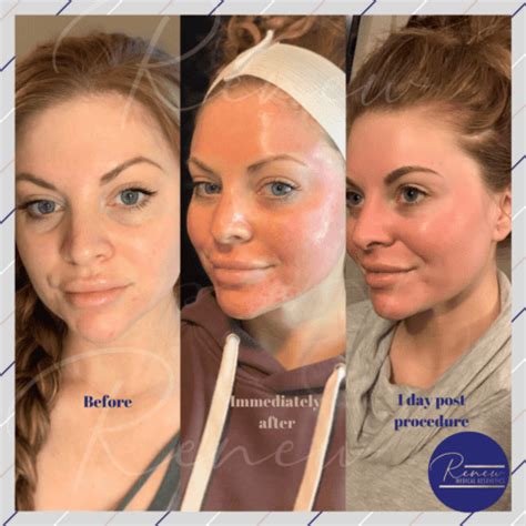 Microneedling - Renew Medical Aesthetics