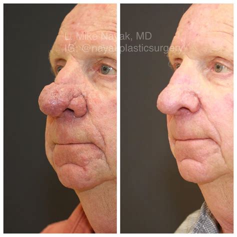 Before & After Rhinophyma Reduction Procedures in St. Louis MO | Nayak