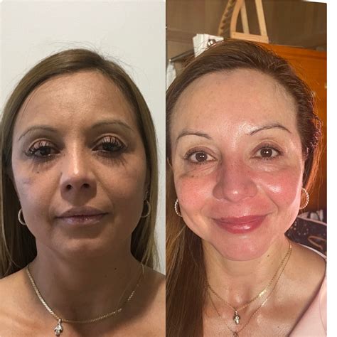 face lift jowls 3