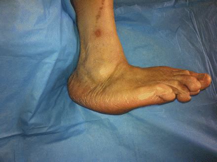 Inflammatory markers at start and end of acute Charcot Arthropathy: Use