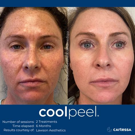 CoolPeel CO2 Laser Resurfacing Treatment in Jacksonville, Florida ...