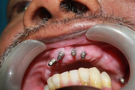 dental implant failure treatment  rosemary henry blog