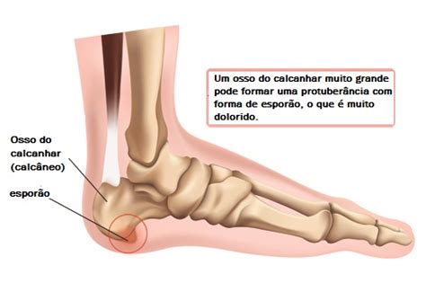 Porque Doi O Calcanhar - A dor no calcanhar: por que isso acontece? - Melhor com Saúde