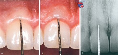 Оптимальный эффект обода как принцип восстановления депульпированных зубов