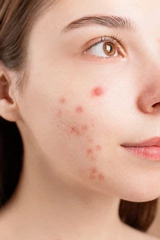 What Causes Pimples On The Face? | Manchas de espinhas, Espinhas, Acne