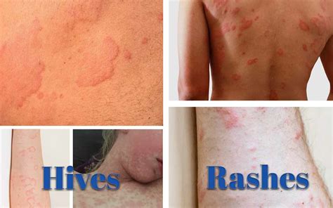 Rash Vs. Hives: How To Identify And Treat Them Naturally