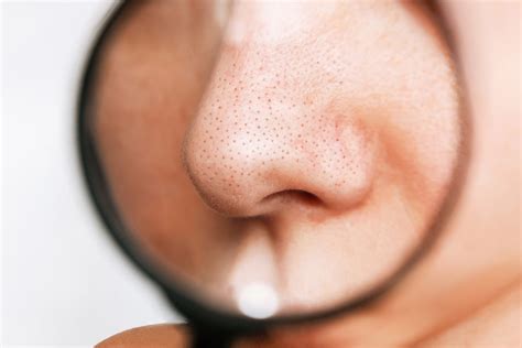 Clogged pores on nose: how to prevent and clean it? — AENO