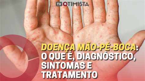 Doença Pé Mão E Boca - Doença mão-pé-boca: o que é, diagnóstico, sintomas e tratamento - TV ...