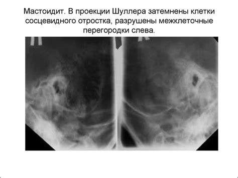 Мастоидит, его формы. Отоантритов, классификация, диагностика и лечение ...