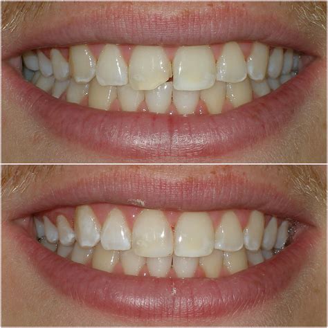 Dentist Rockville Maryland - Dental Bonding | Sherman Family Dentistry