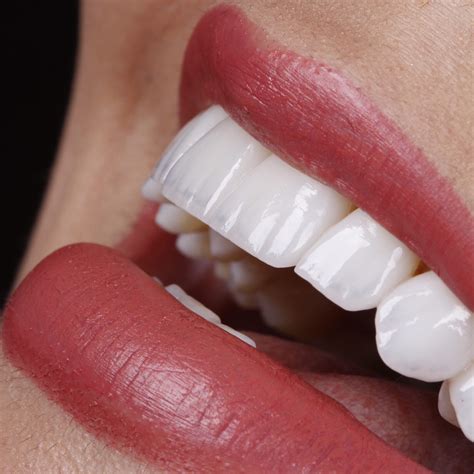 O perigo do sorriso perfeito